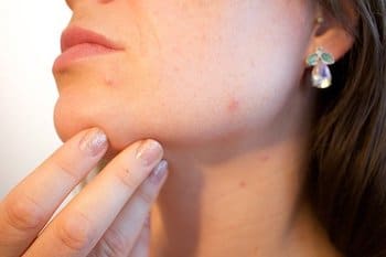 CBD Oil against acne